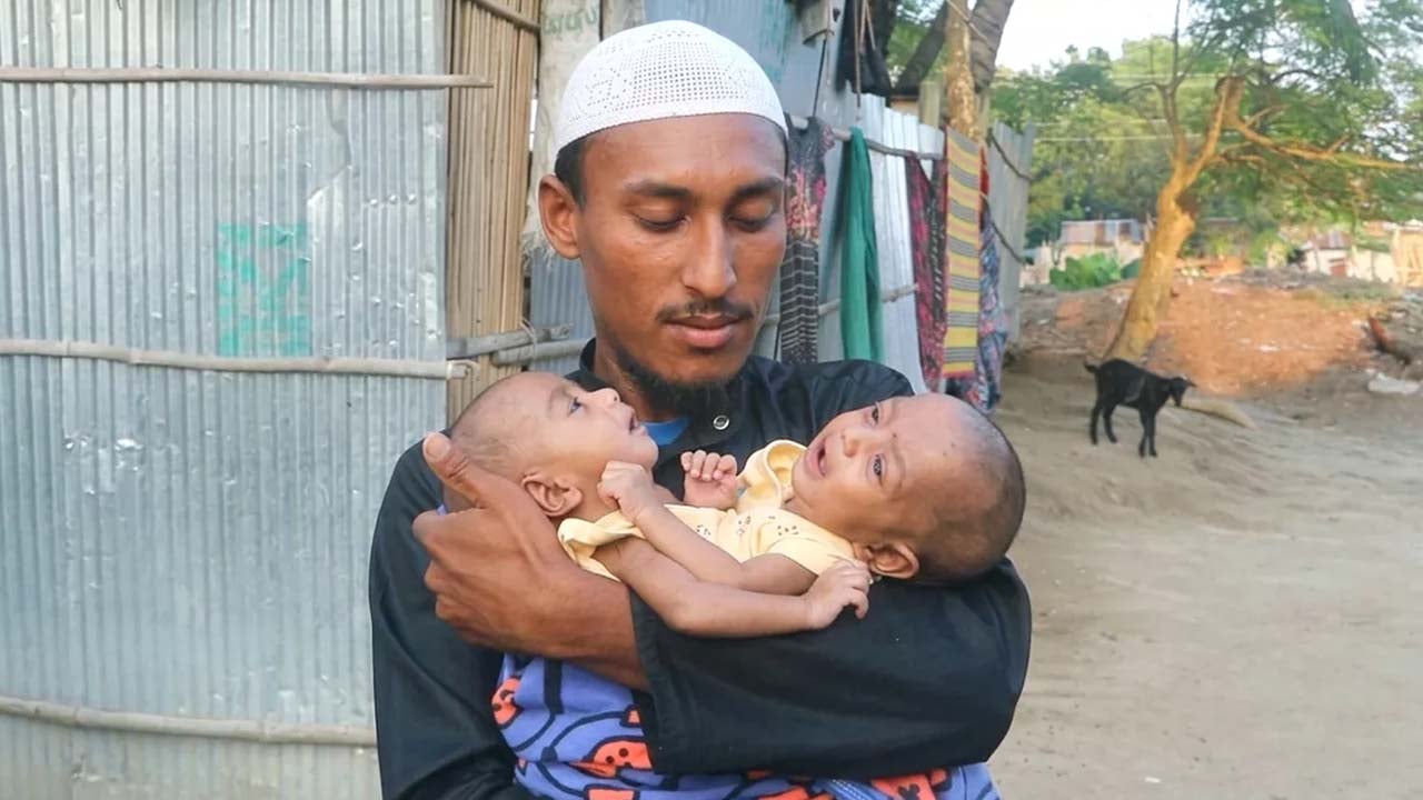 জোড়া শিশু জয়নব ও কুলসুম কি পাবে তাদের স্বাভাবিক জীবন