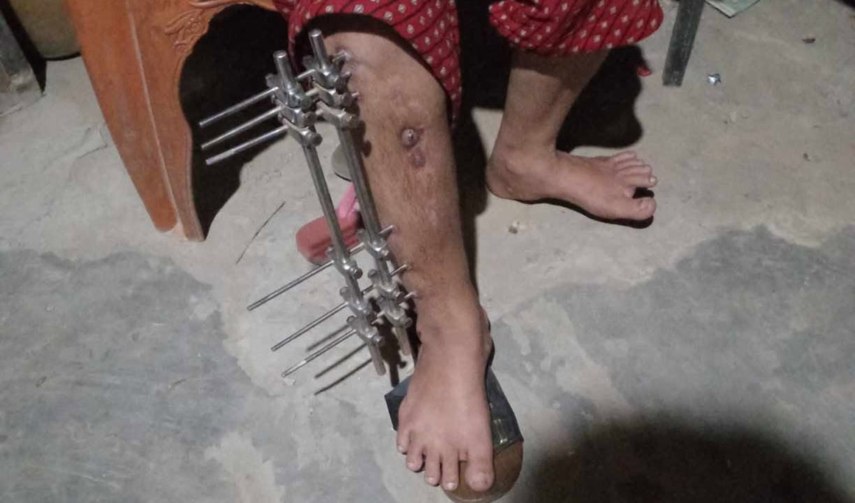 পা বাঁচাতে রূপালীর প্রয়োজন ১ লাখ টাকা, সহযোগিতা চায় অসহায় পরিবার