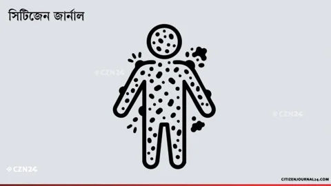 হাম উপসর্গে আরও ৮ শিশুর মৃত্যু