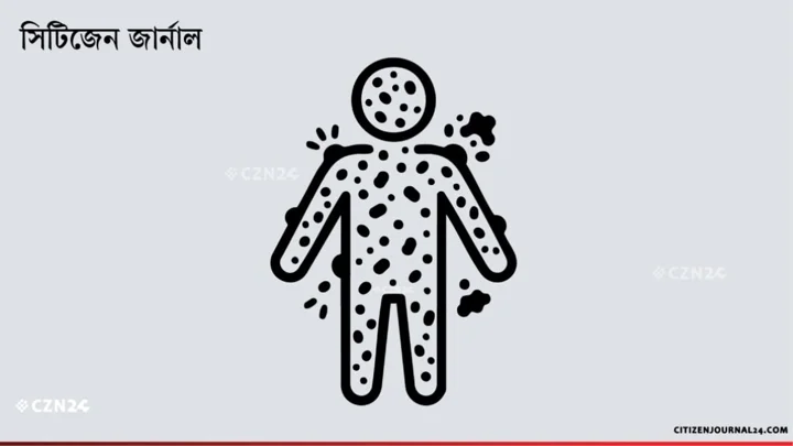 হাম ও উপসর্গে আরও ৪ শিশুর প্রাণহানি