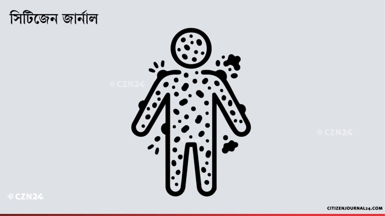 হাম উপসর্গে আরও ৮ শিশুর মৃত্যু