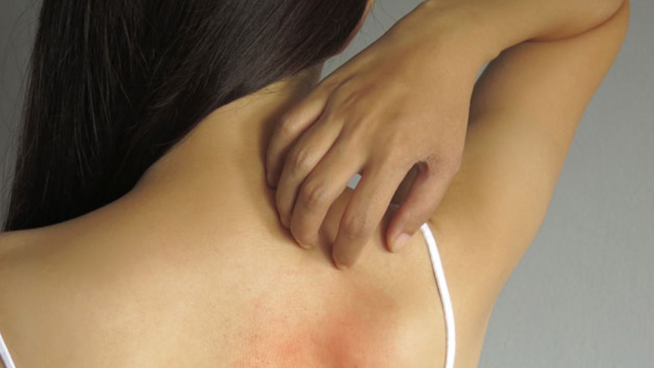 গরমে ত্বকে ঘামাচি সমস্যার কারণ ও ঘরোয়া সমাধান