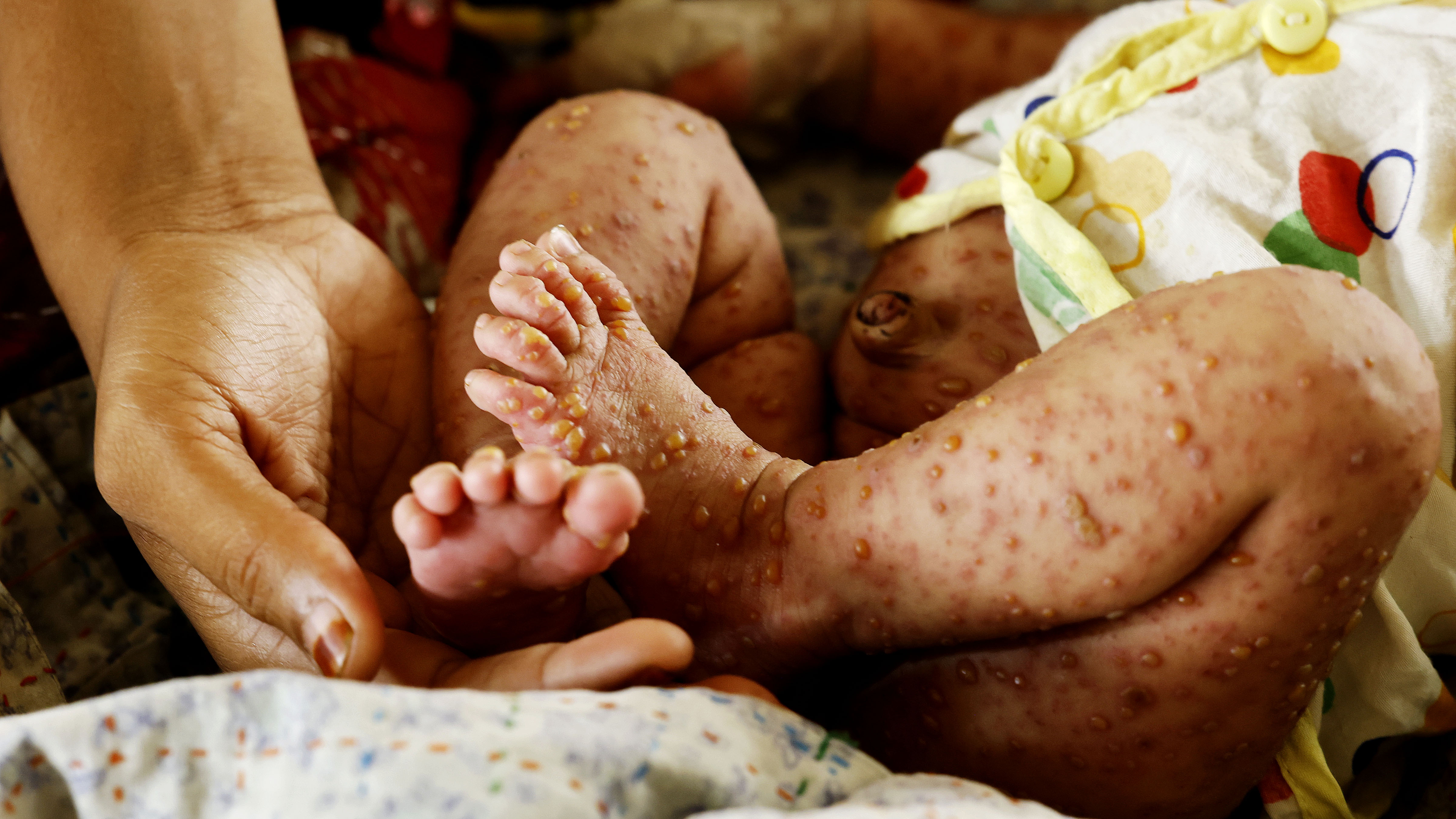 সারা শরীরে লালচে র্যাশ উঠে যাওয়ায় সন্তানকে সাবধানে ধরছেন মা