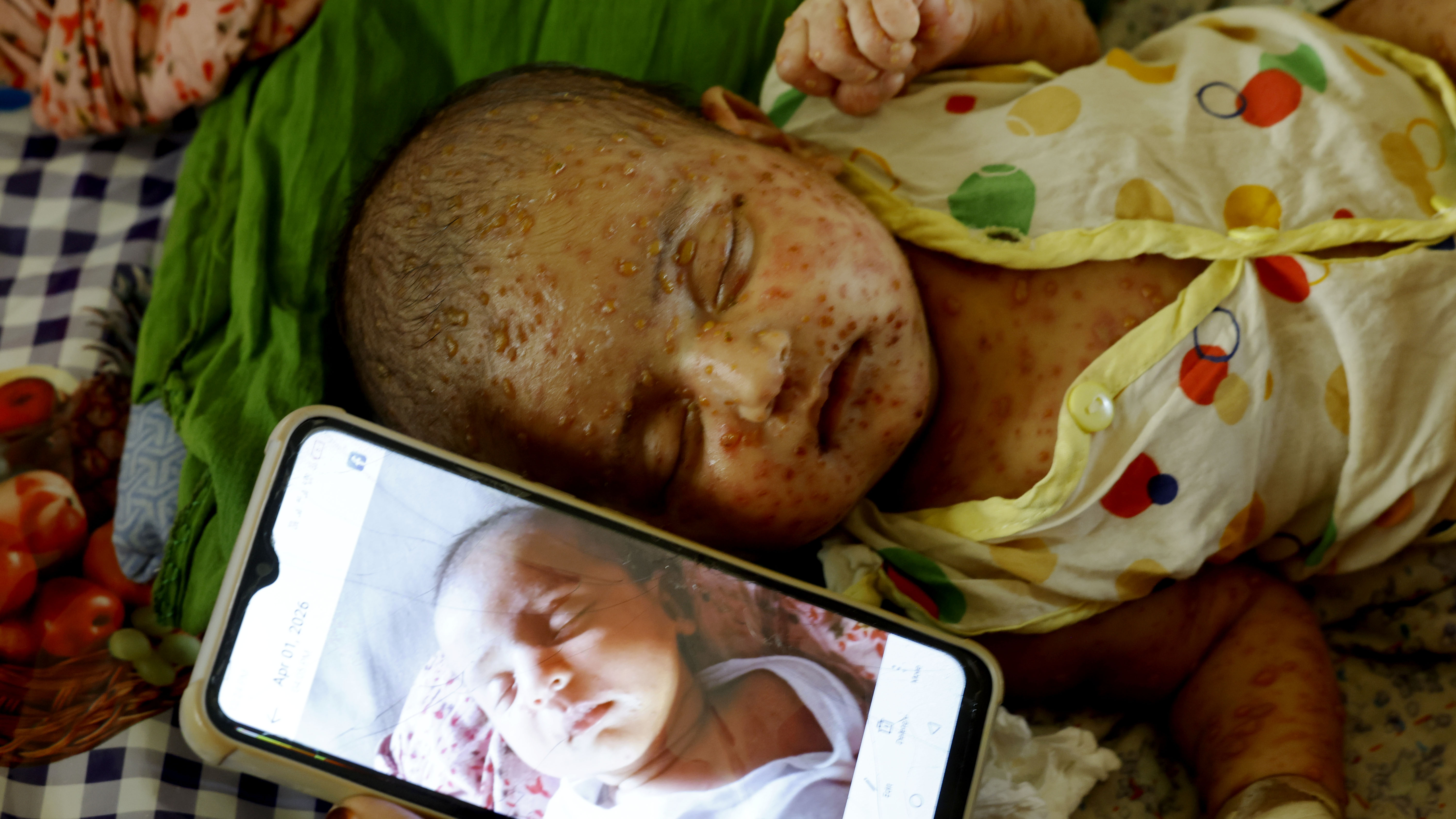 হামের ভয়াবহতা