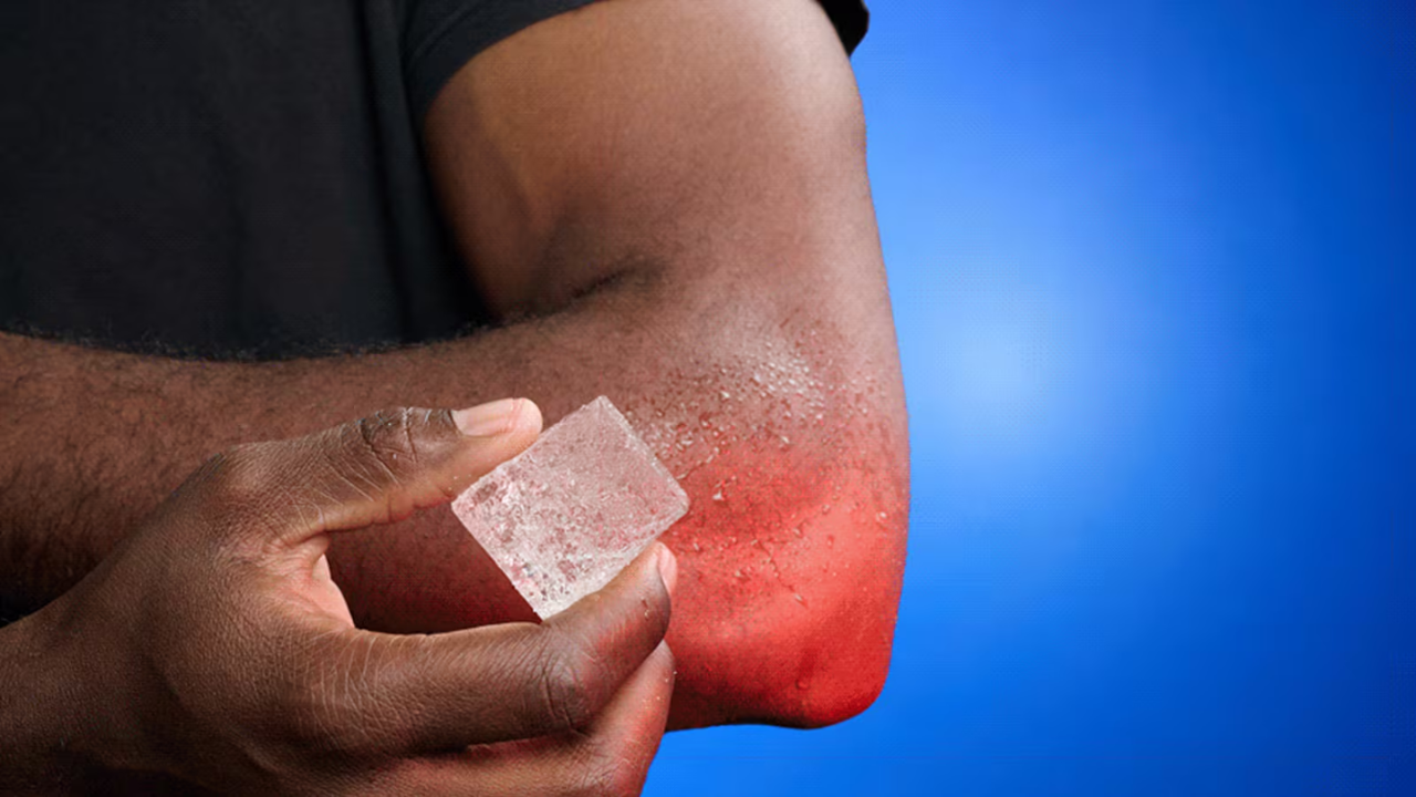 শরীরের পুড়ে যাওয়া স্থানে বরফ দিলে লাভ না ক্ষতি