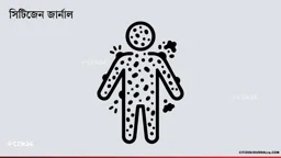 হামের উপসর্গে আরও ৪ শিশুর মৃত্যু