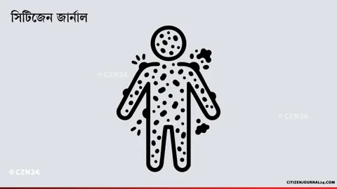হামের উপসর্গে আরও ৪ শিশুর মৃত্যু