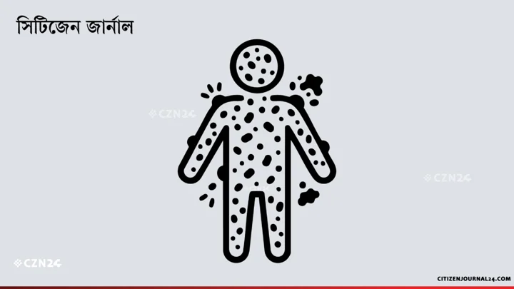 হামের উপসর্গে একদিনে আরও ৪ শিশুর মৃত্যু