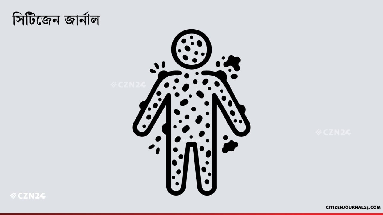 হামের উপসর্গে আরও ৪ শিশুর মৃত্যু